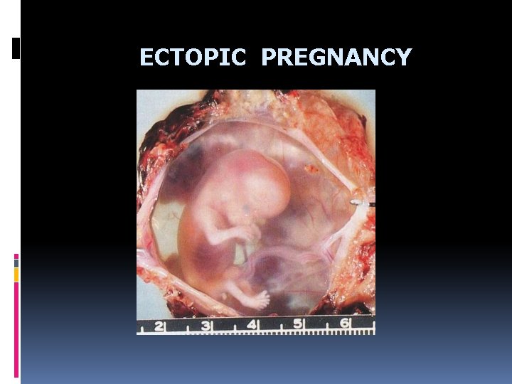 ECTOPIC PREGNANCY 