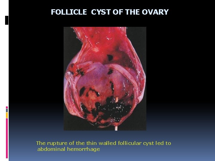 FOLLICLE CYST OF THE OVARY The rupture of the thin walled follicular cyst led