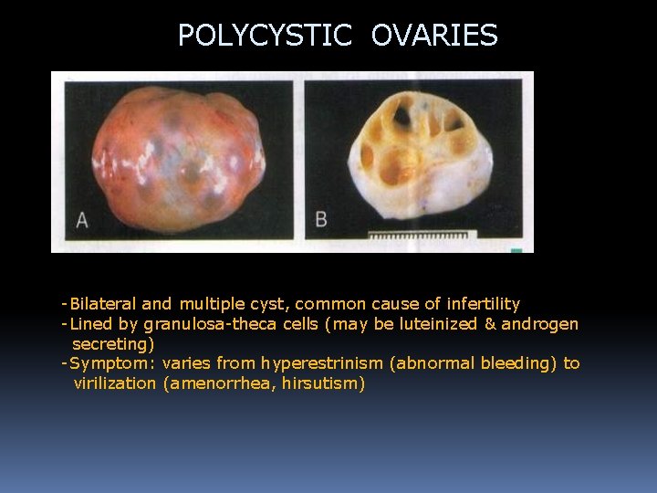 POLYCYSTIC OVARIES -Bilateral and multiple cyst, common cause of infertility -Lined by granulosa-theca cells