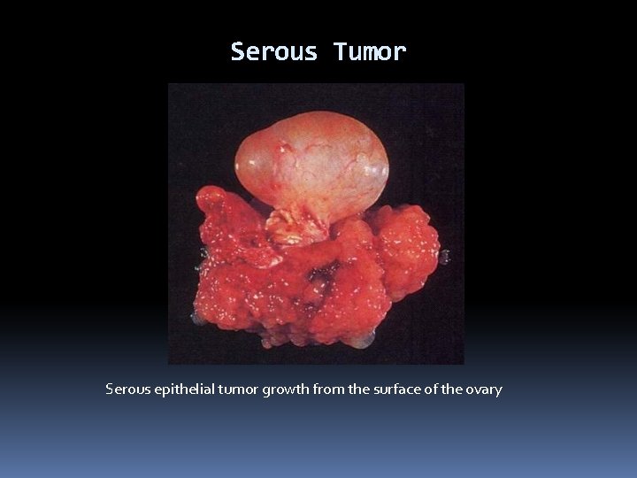 Serous Tumor Serous epithelial tumor growth from the surface of the ovary 