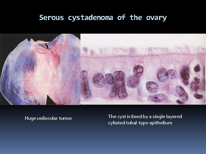 Serous cystadenoma of the ovary Huge unilocular tumor The cyst is lined by a