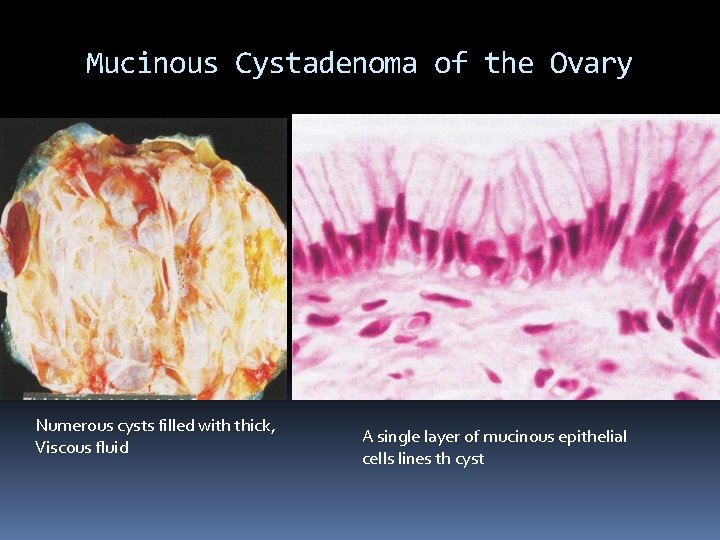 Mucinous Cystadenoma of the Ovary Numerous cysts filled with thick, Viscous fluid A single