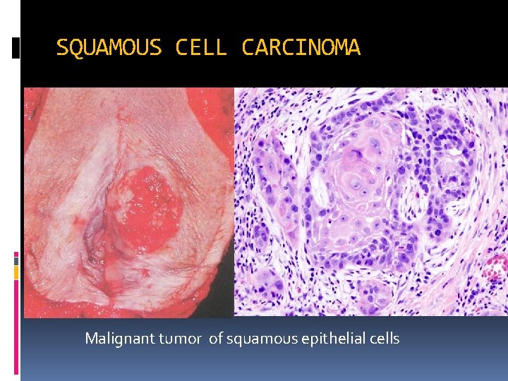 SQUAMOUS CELL CARCINOMA keratinization Malignant tumor of squamous epithelial cells 