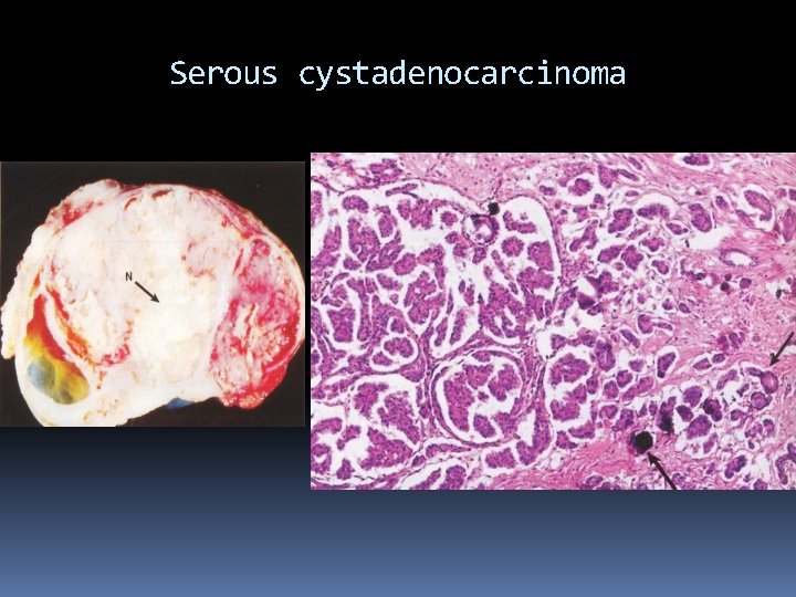Serous cystadenocarcinoma 
