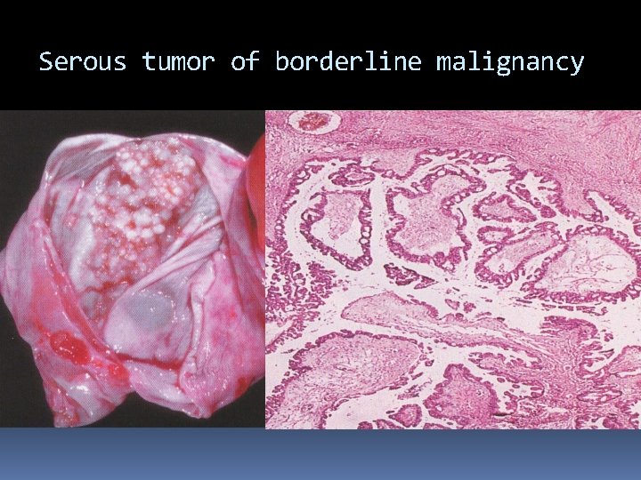 Serous tumor of borderline malignancy 