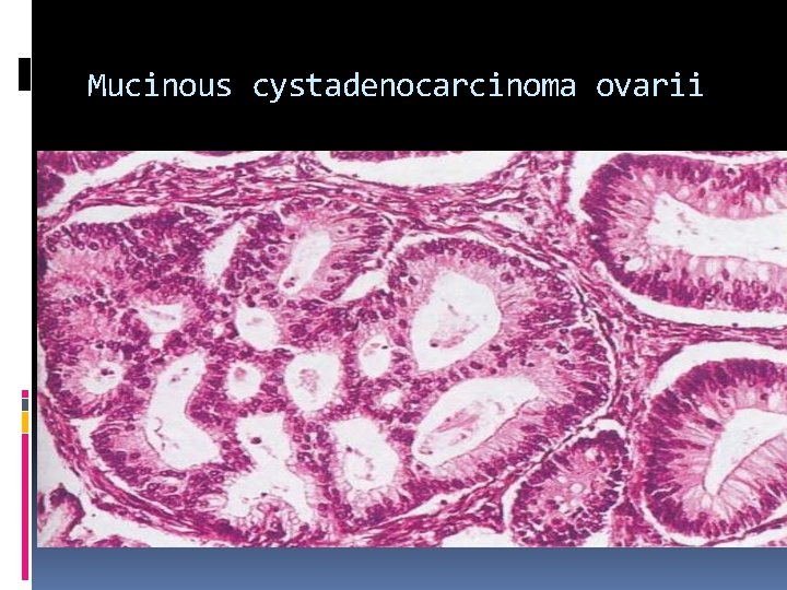 Mucinous cystadenocarcinoma ovarii 