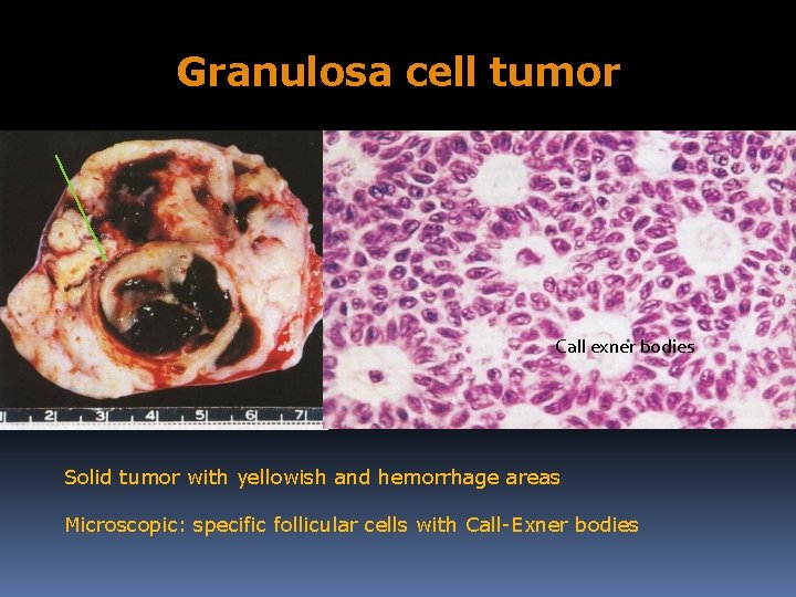 Granulosa cell tumor Call exner bodies Solid tumor with yellowish and hemorrhage areas Microscopic: