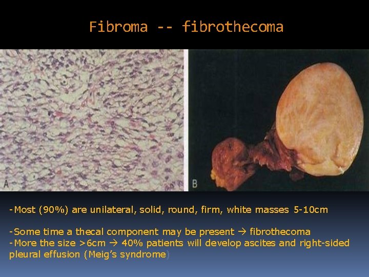 Fibroma -- fibrothecoma -Most (90%) are unilateral, solid, round, firm, white masses 5 -10