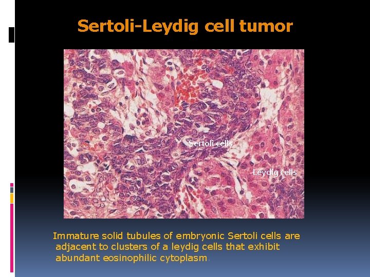 Sertoli-Leydig cell tumor Sertoli cells Leydig cells Immature solid tubules of embryonic Sertoli cells