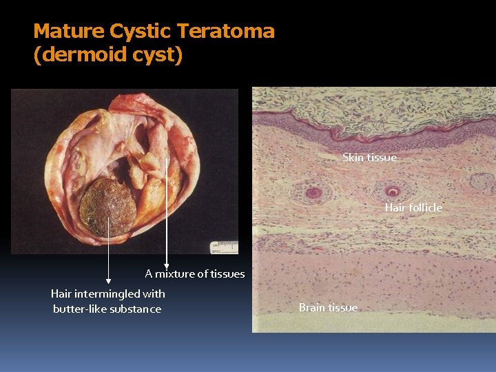 Mature Cystic Teratoma (dermoid cyst) Skin tissue Hair follicle A mixture of tissues Hair