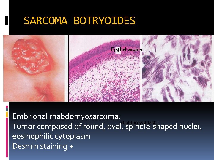 SARCOMA BOTRYOIDES Epithel vagina Embrional rhabdomyosarcoma: rhaldomyoblast Tumor composed of round, oval, spindle-shaped nuclei,