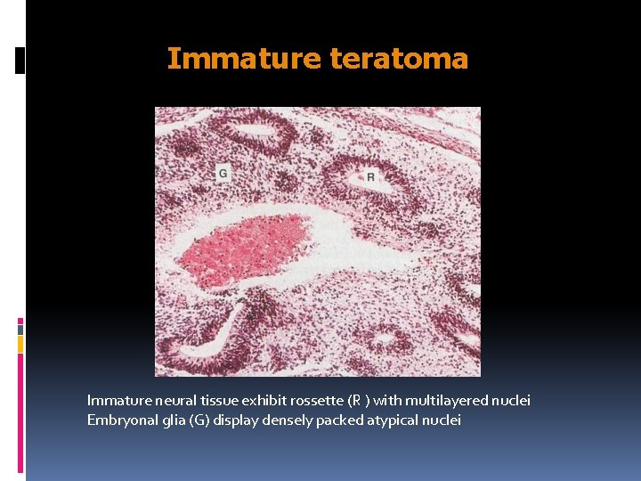 Immature teratoma Immature neural tissue exhibit rossette (R ) with multilayered nuclei Embryonal glia