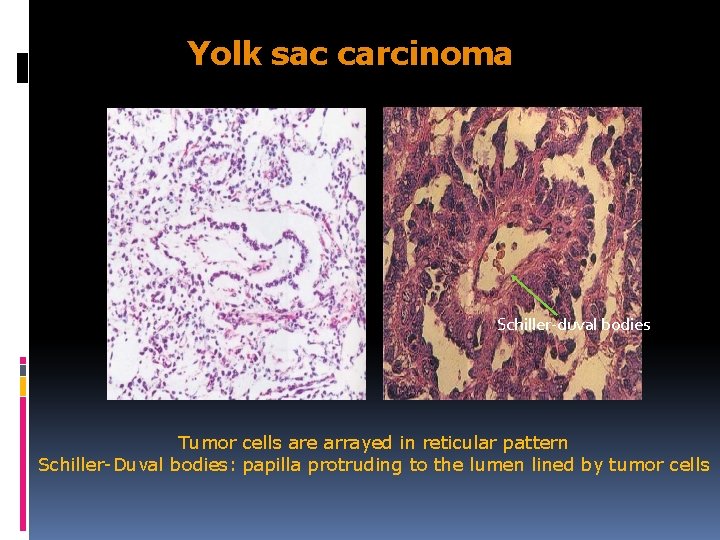 Yolk sac carcinoma Schiller-duval bodies Tumor cells are arrayed in reticular pattern Schiller-Duval bodies: