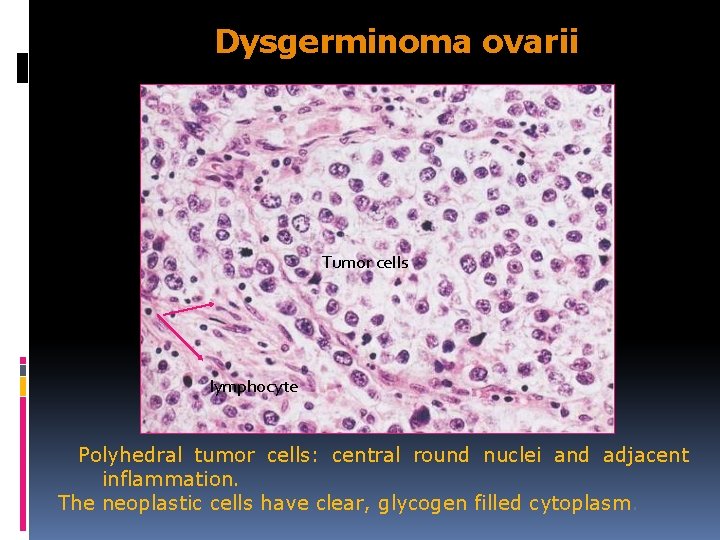 Dysgerminoma ovarii Tumor cells lymphocyte Polyhedral tumor cells: central round nuclei and adjacent inflammation.