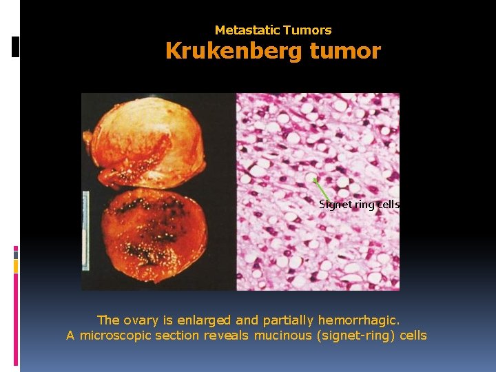 Metastatic Tumors Krukenberg tumor Signet ring cells The ovary is enlarged and partially hemorrhagic.