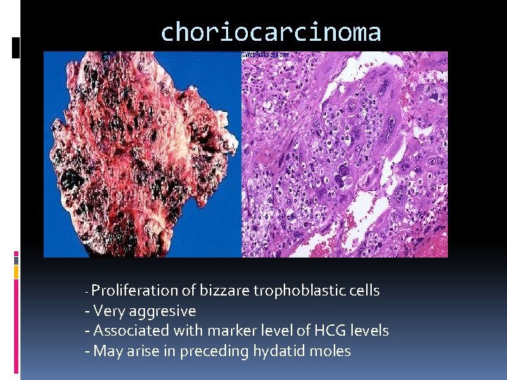 choriocarcinoma - Proliferation of bizzare trophoblastic cells - Very aggresive - Associated with marker