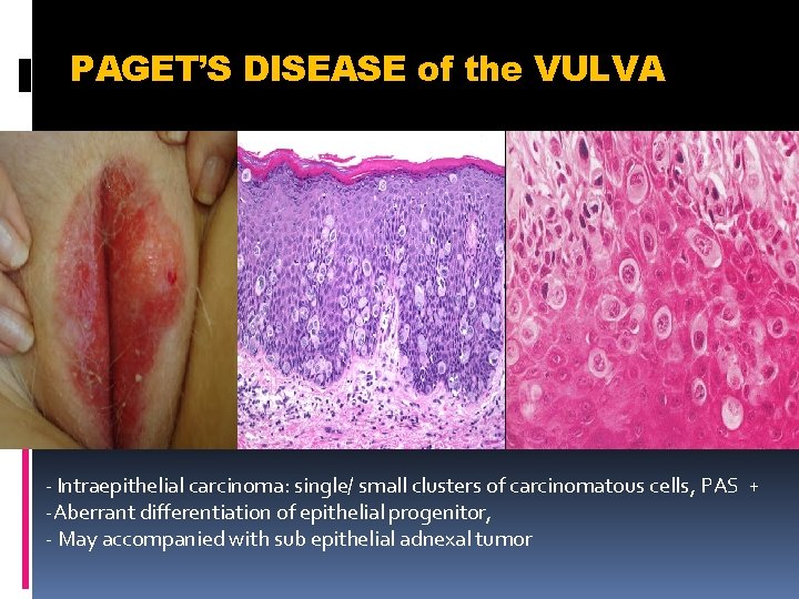 PAGET’S DISEASE of the VULVA - Intraepithelial carcinoma: single/ small clusters of carcinomatous cells,