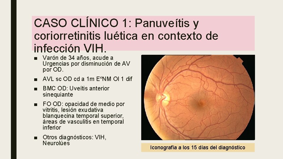 CASO CLÍNICO 1: Panuveítis y coriorretinitis luética en contexto de infección VIH. ■ Varón CASO CLÍNICO 1: Panuveítis y coriorretinitis luética en contexto de infección VIH. ■ Varón