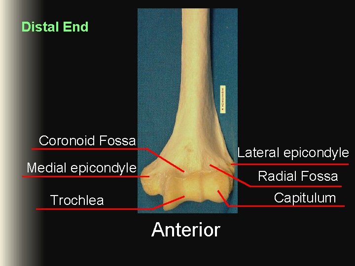 Distal End Coronoid Fossa Lateral epicondyle Medial epicondyle Radial Fossa Capitulum Trochlea Anterior Distal End Coronoid Fossa Lateral epicondyle Medial epicondyle Radial Fossa Capitulum Trochlea Anterior