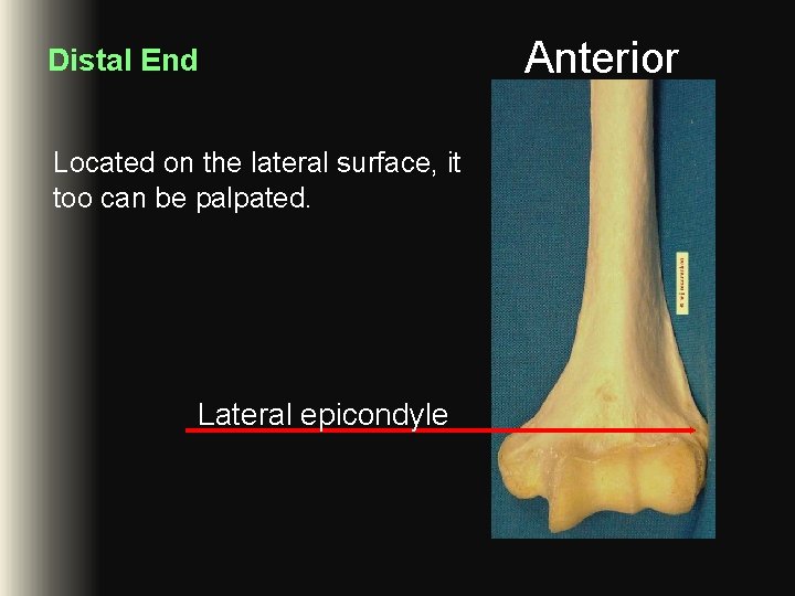 Distal End Located on the lateral surface, it too can be palpated. Lateral epicondyle Distal End Located on the lateral surface, it too can be palpated. Lateral epicondyle