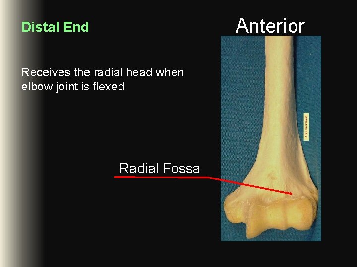 Anterior Distal End Receives the radial head when elbow joint is flexed Radial Fossa Anterior Distal End Receives the radial head when elbow joint is flexed Radial Fossa