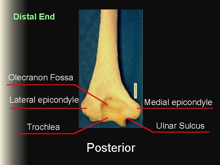 Distal End Olecranon Fossa Lateral epicondyle Medial epicondyle Trochlea Ulnar Sulcus Posterior Distal End Olecranon Fossa Lateral epicondyle Medial epicondyle Trochlea Ulnar Sulcus Posterior