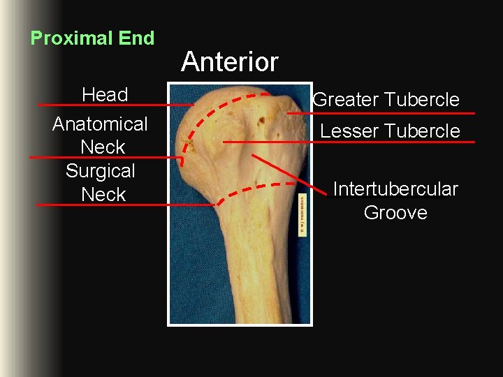 Proximal End Head Anatomical Neck Surgical Neck Anterior Greater Tubercle Lesser Tubercle Intertubercular Groove Proximal End Head Anatomical Neck Surgical Neck Anterior Greater Tubercle Lesser Tubercle Intertubercular Groove