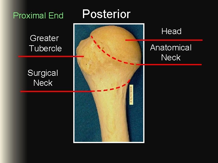 Proximal End Greater Tubercle Surgical Neck Posterior Head Anatomical Neck Proximal End Greater Tubercle Surgical Neck Posterior Head Anatomical Neck