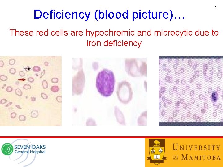Deficiency (blood picture)… 20 These red cells are hypochromic and microcytic due to iron