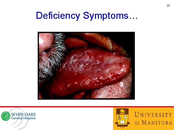 23 Deficiency Symptoms… 