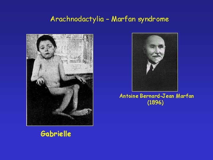 Arachnodactylia – Marfan syndrome Antoine Bernard-Jean Marfan (1896) Gabrielle 
