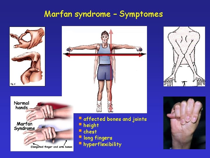 Marfan syndrome – Symptomes § affected bones and joints § height § chest §