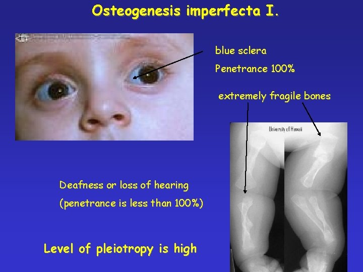 Osteogenesis imperfecta I. blue sclera Penetrance 100% extremely fragile bones Deafness or loss of