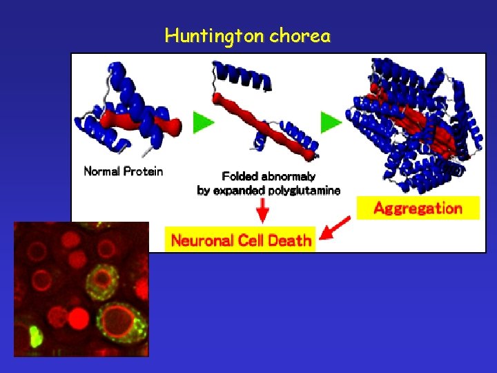 Huntington chorea 