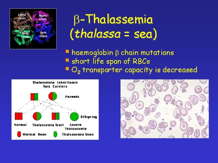 b-Thalassemia (thalassa = sea) § haemoglobin b chain mutations § short life span of