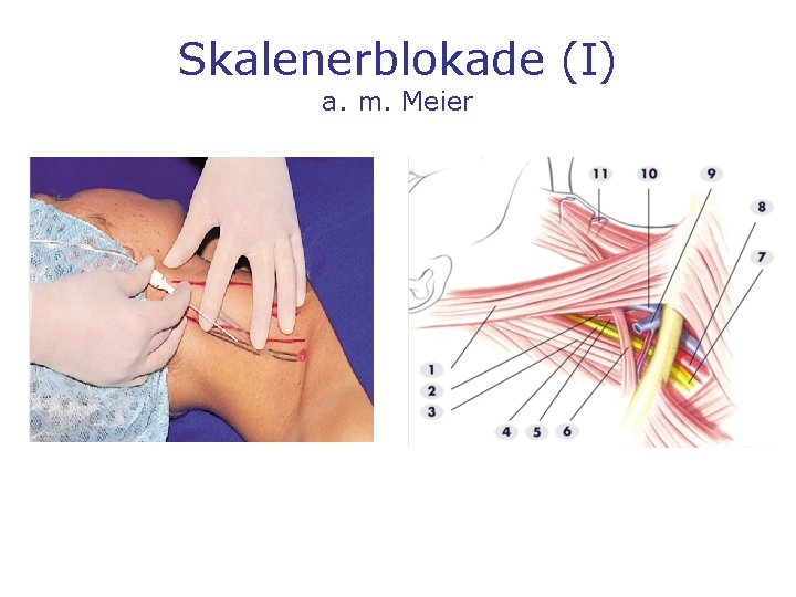 Skalenerblokade (I) a. m. Meier 