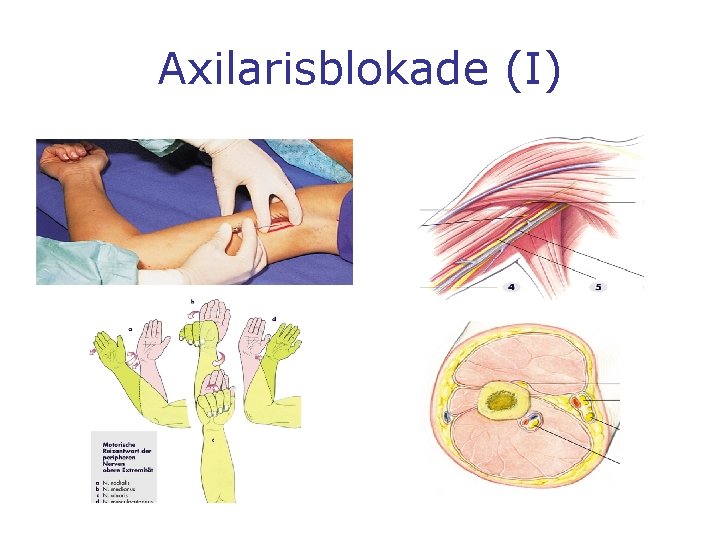 Axilarisblokade (I) 