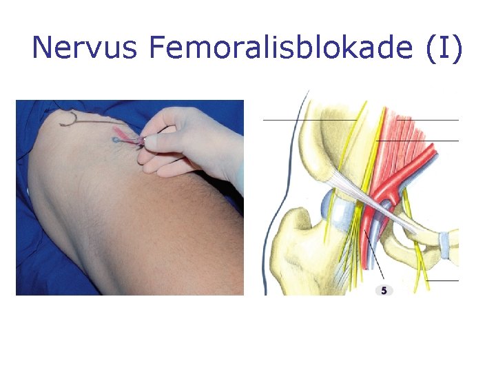 Nervus Femoralisblokade (I) 