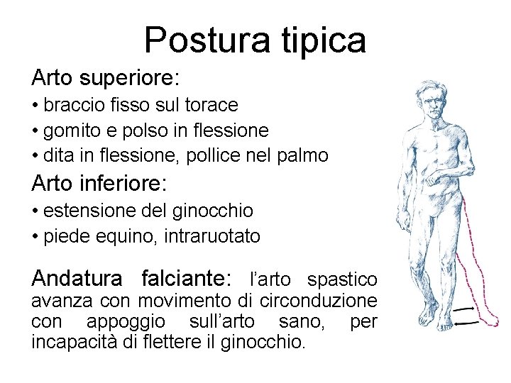 Postura tipica Arto superiore: • braccio fisso sul torace • gomito e polso in