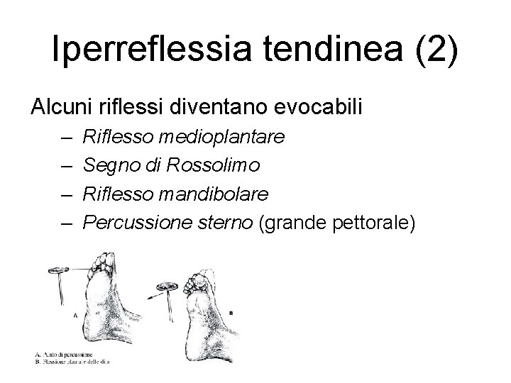 Iperreflessia tendinea (2) Alcuni riflessi diventano evocabili – – Riflesso medioplantare Segno di Rossolimo