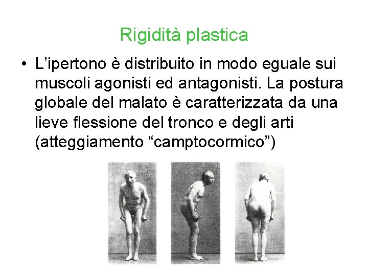 Rigidità plastica • L’ipertono è distribuito in modo eguale sui muscoli agonisti ed antagonisti.