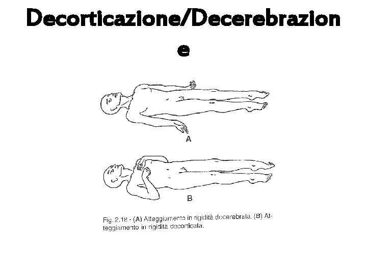 Decorticazione/Decerebrazion e 