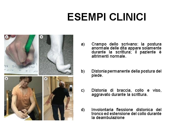 ESEMPI CLINICI a) Crampo dello scrivano: la postura anormale delle dita appare solamente durante