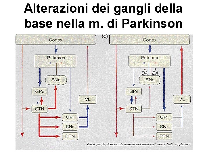 Alterazioni dei gangli della base nella m. di Parkinson 