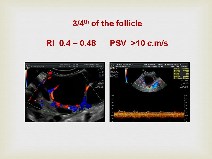 3/4 th of the follicle RI 0. 4 – 0. 48 - PSV >10