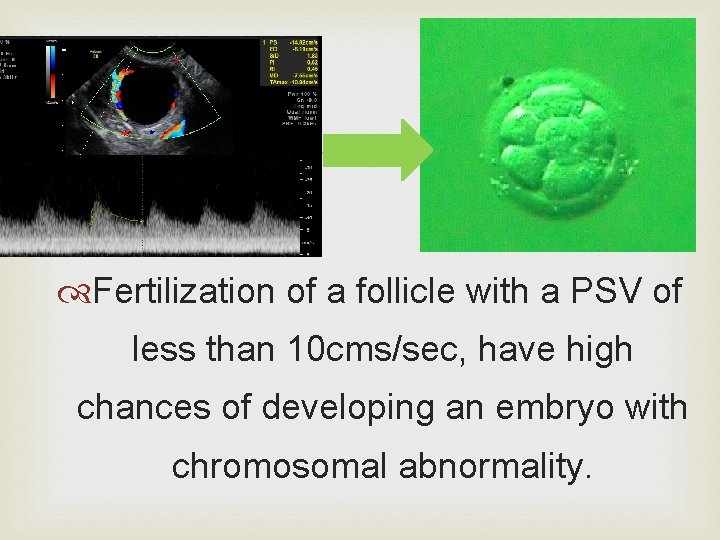  Fertilization of a follicle with a PSV of less than 10 cms/sec, have