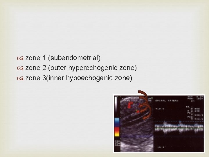  zone 1 (subendometrial) zone 2 (outer hyperechogenic zone) zone 3(inner hypoechogenic zone) 