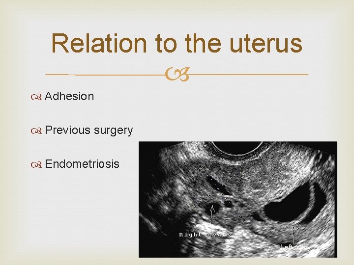 Relation to the uterus Adhesion Previous surgery Endometriosis 