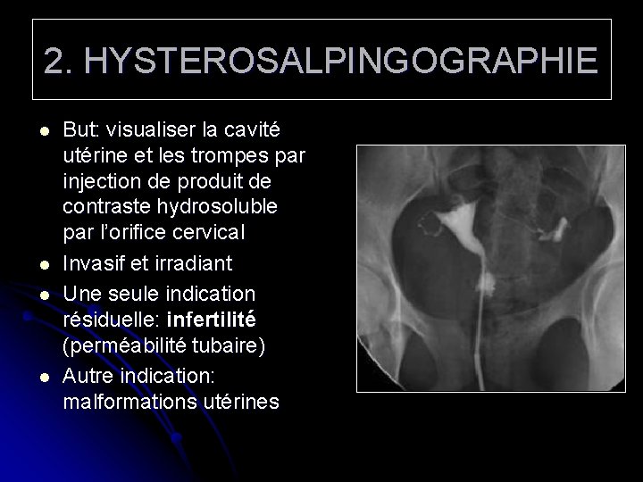 2. HYSTEROSALPINGOGRAPHIE l l But: visualiser la cavité utérine et les trompes par injection