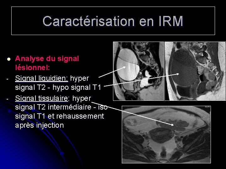 Caractérisation en IRM l - Analyse du signal lésionnel: Signal liquidien: hyper signal T